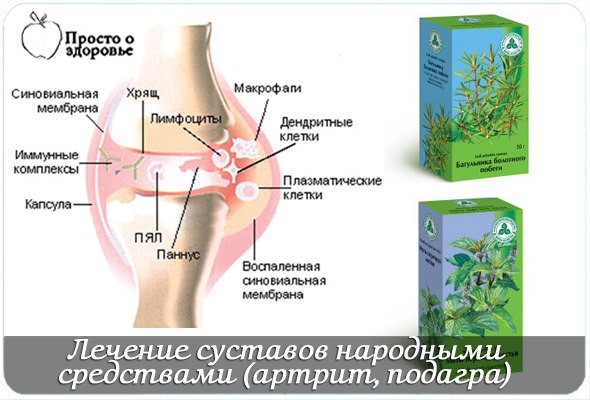 Лечение суставов народными средствами (артрит, подагра).